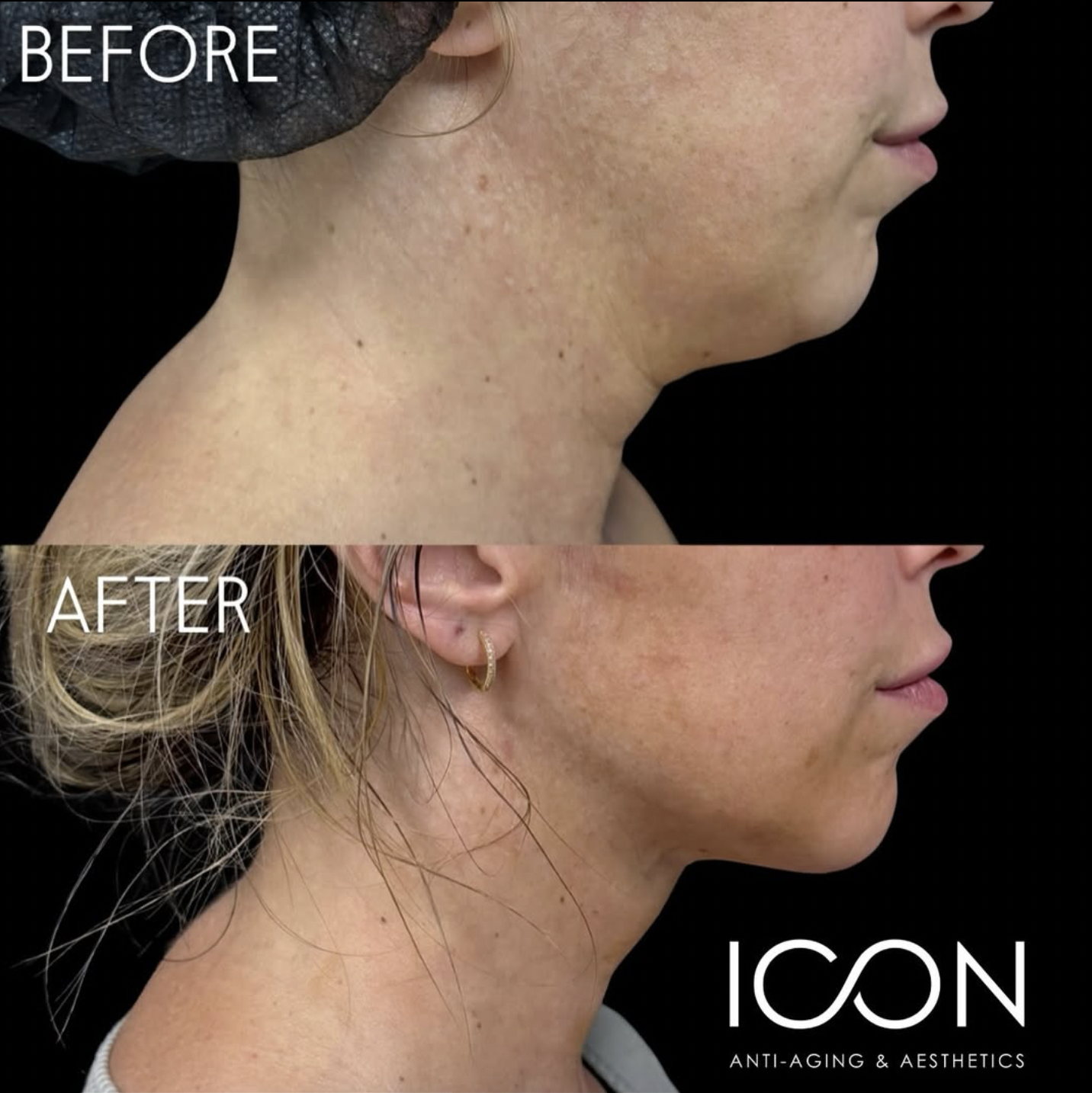chin lipo